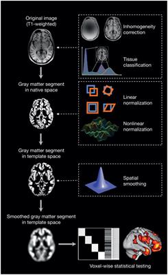 Unraveling the pathophysiology of schizophrenia: insights from structural magnetic resonance imaging studies